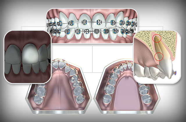 Брекеты и удаление зубов