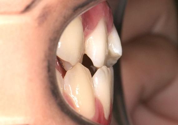 искривление зубов в 11 лет в профиль