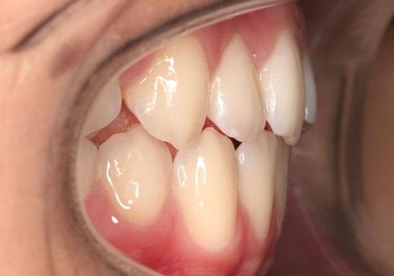 здоровые зубы в 11 лет в профиль