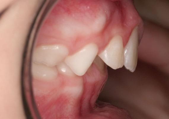искривление зубов в 7 лет в профиль