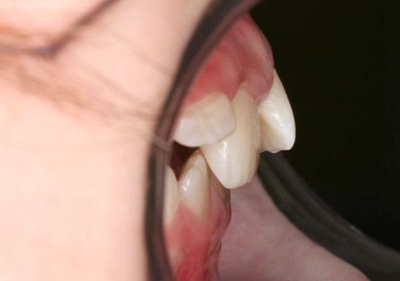 curvature of teeth 3-6 years side