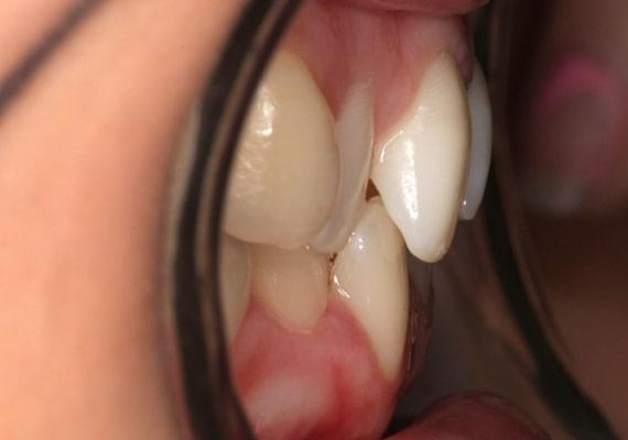 искривление зубов