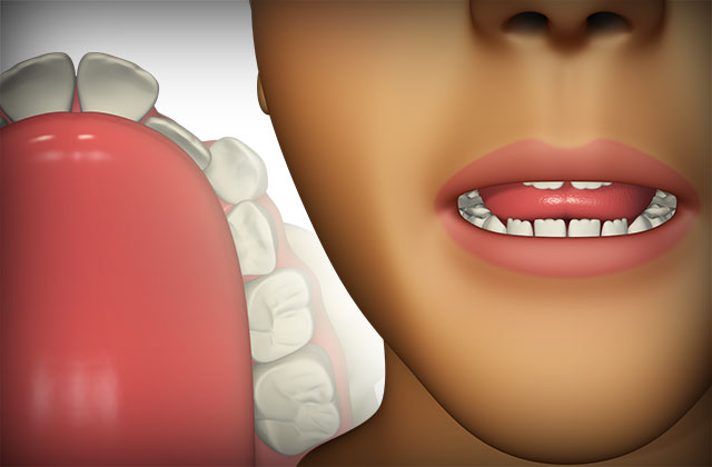 Pobres hábitos orales son las causas de los dientes apiñados